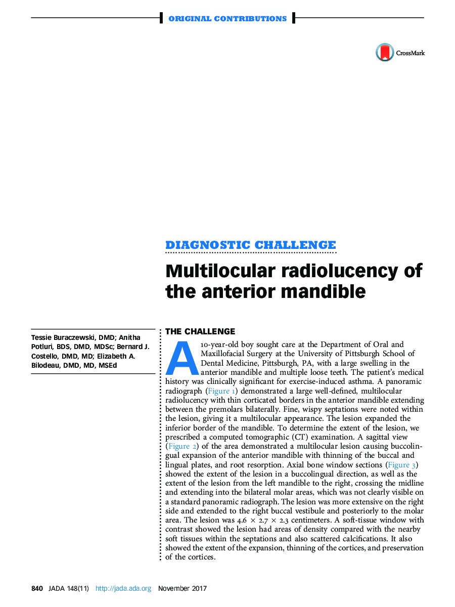 Multilocular radiolucency of the anterior mandible