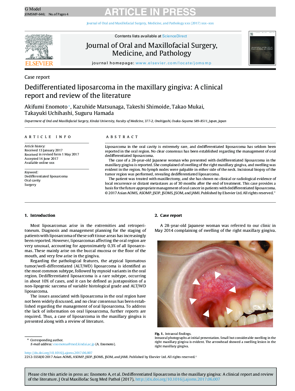 Dedifferentiated liposarcoma in the maxillary gingiva: A clinical report and review of the literature