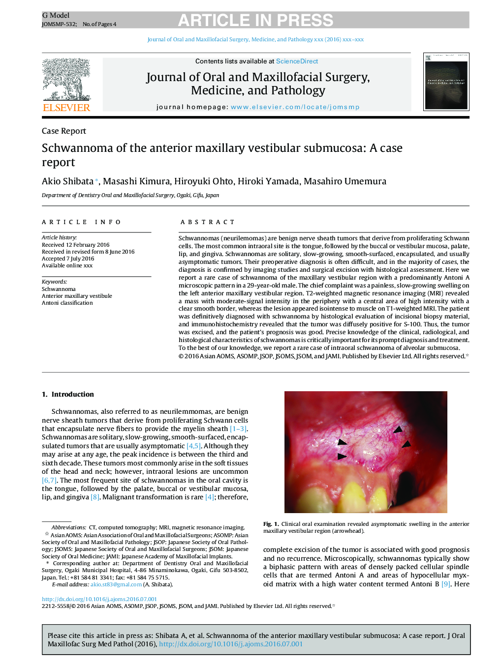 Schwannoma of the anterior maxillary vestibular submucosa: A case report