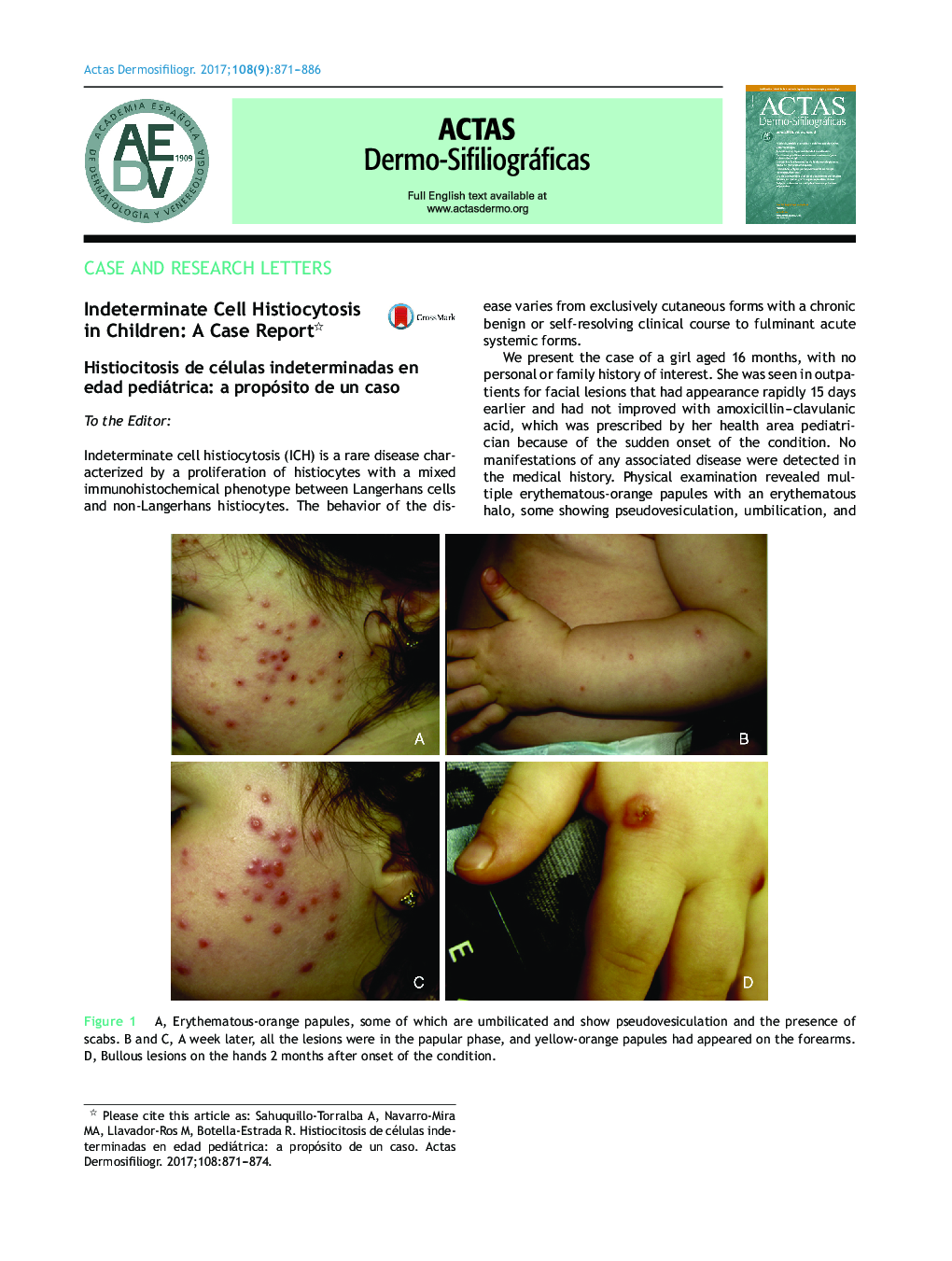 Indeterminate Cell Histiocytosis in Children: A Case Report