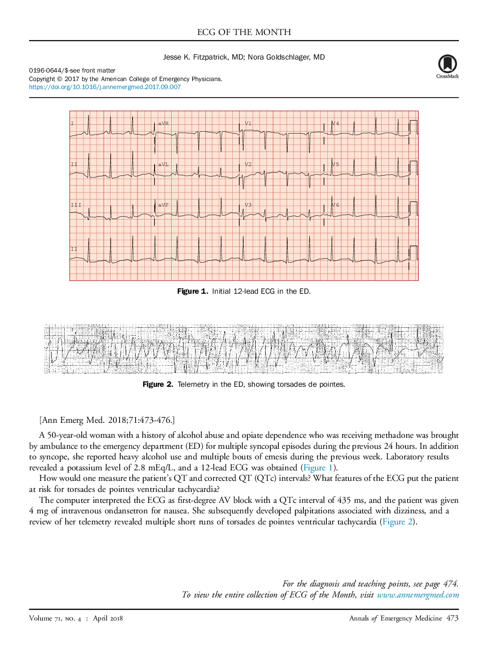 The Clue Is in the U Wave: Torsades de Pointes Ventricular Tachycardia in a Hypokalemic Woman on Methadone