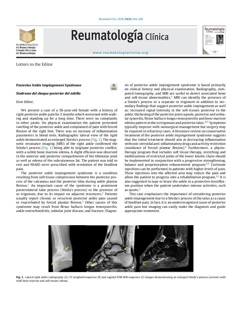 Posterior Ankle Impingement Syndrome