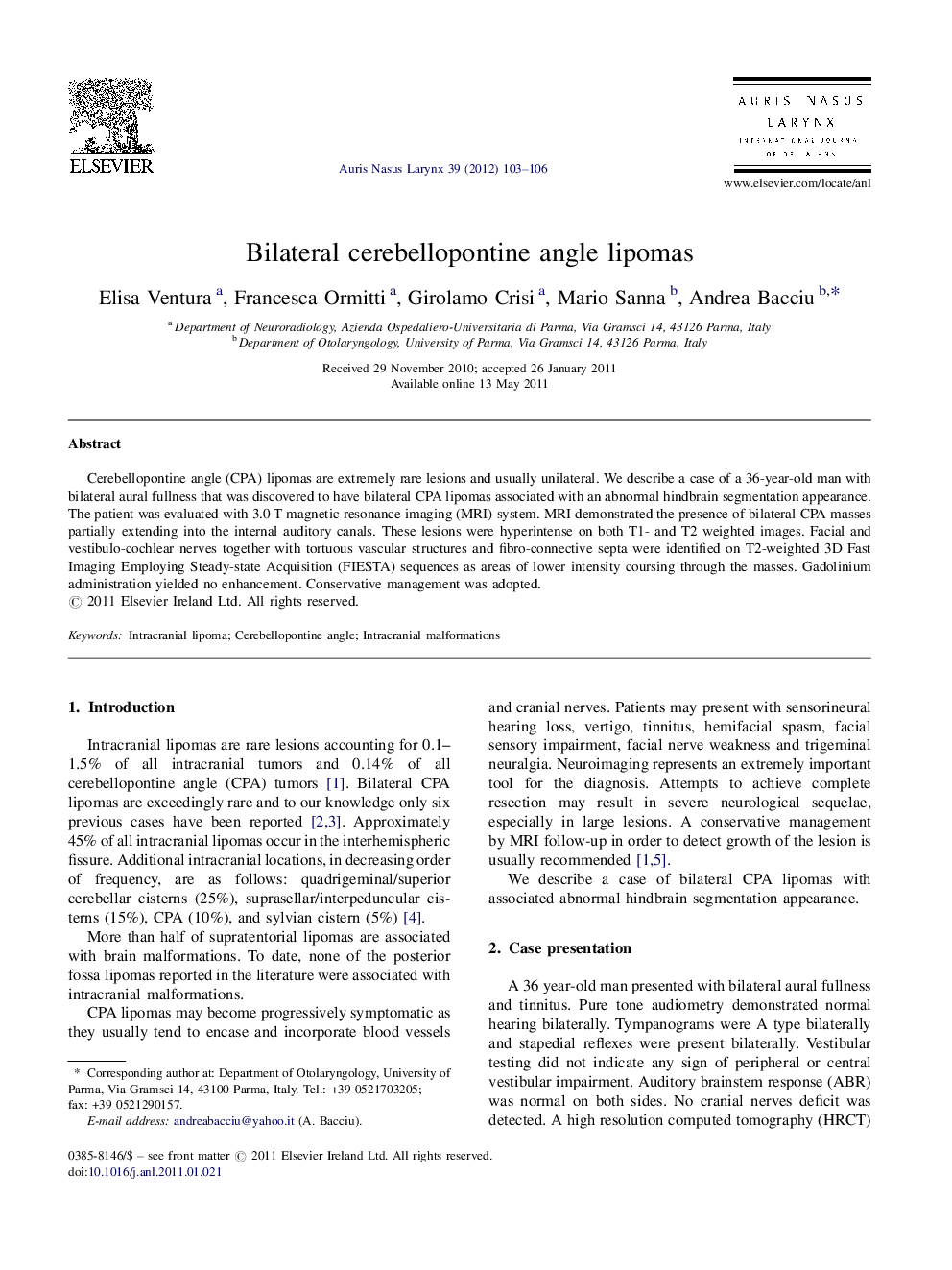 Bilateral cerebellopontine angle lipomas