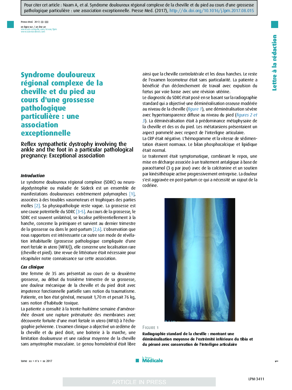 Syndrome douloureux régional complexe de la cheville et du pied au cours d'une grossesse pathologique particuliÃ¨reÂ : une association exceptionnelle