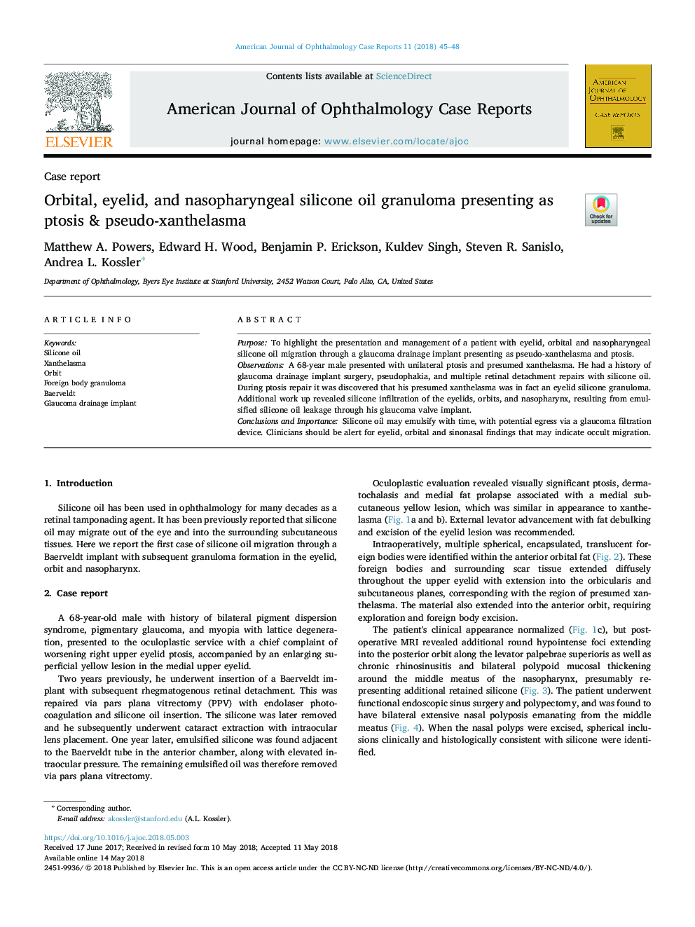 Orbital, eyelid, and nasopharyngeal silicone oil granuloma presenting as ptosis & pseudo-xanthelasma
