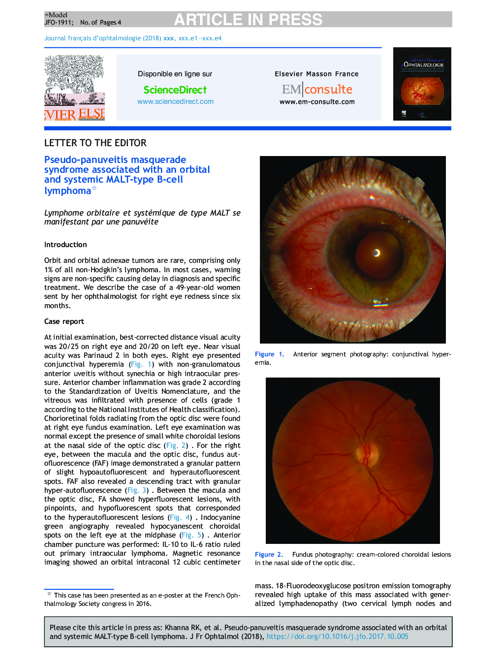 Pseudo-panuveitis masquerade syndrome associated with an orbital and systemic MALT-type B-cell lymphoma