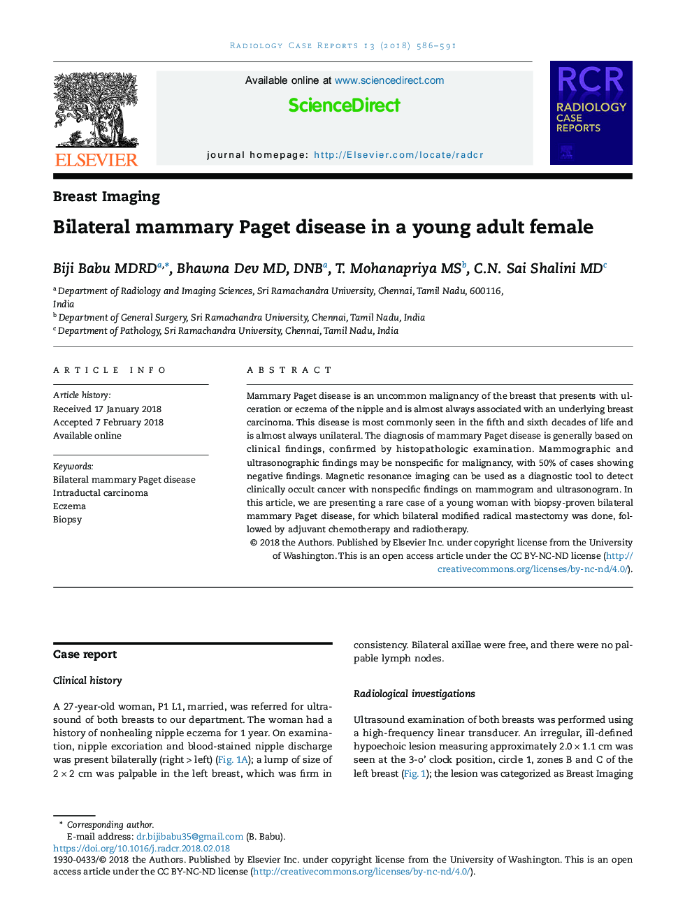 Bilateral mammary Paget disease in a young adult female