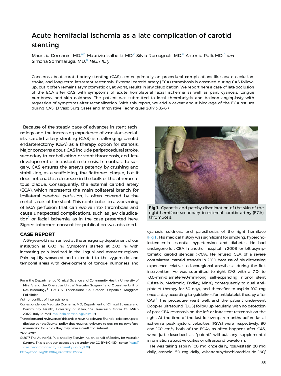 Acute hemifacial ischemia as a late complication of carotid stenting