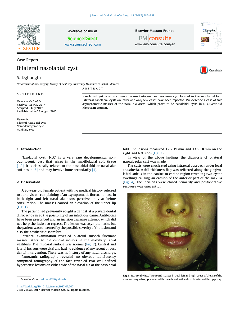 Bilateral nasolabial cyst