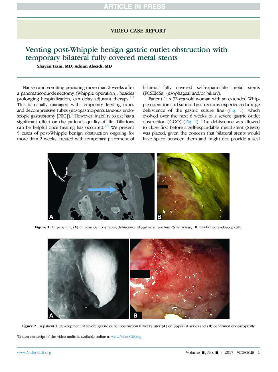 Venting post-Whipple benign gastric outlet obstruction with temporary bilateral fully covered metal stents