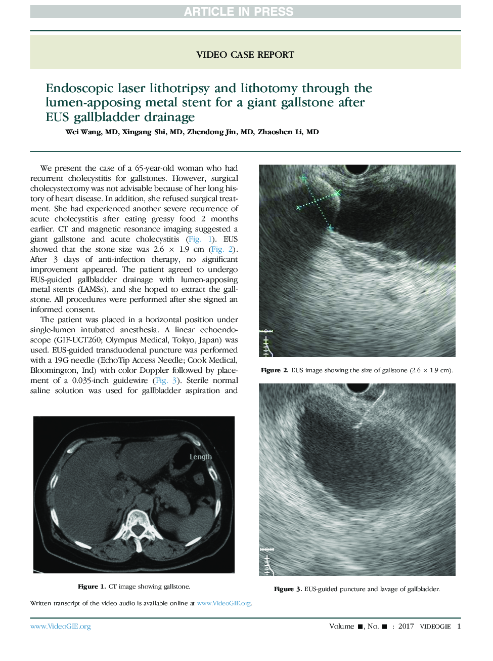 Endoscopic laser lithotripsy and lithotomy through the lumen-apposing metal stent for a giant gallstone after EUSÂ gallbladder drainage