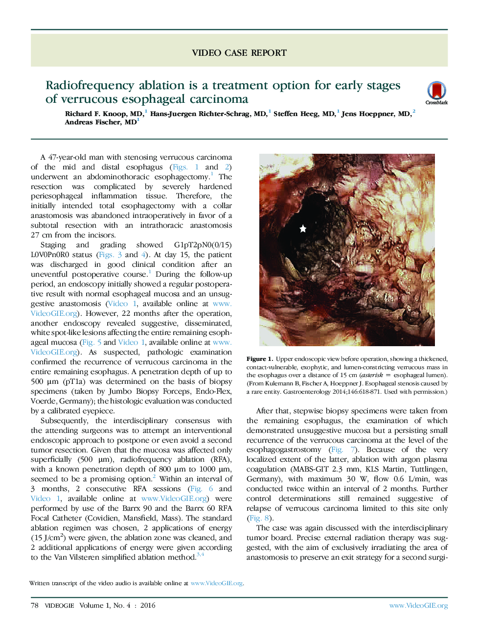 عکس صفحه اول مقاله: Radiofrequency ablation is a treatment option for early stages of verrucous esophageal carcinoma Radiofrequency ablation is a treatment option for early stages of verrucous esophageal carcinoma