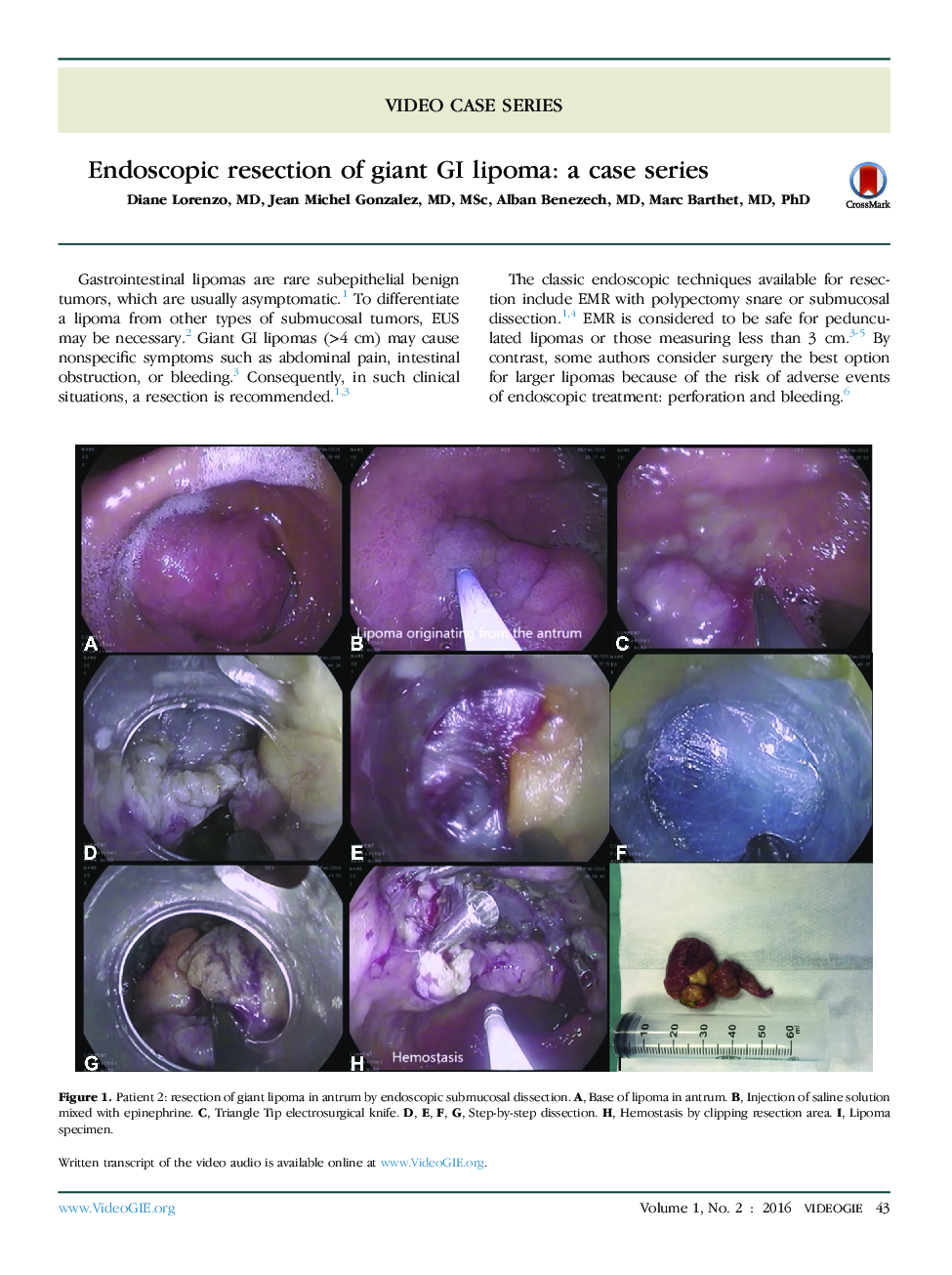 عکس صفحه اول مقاله: Endoscopic resection of giant GI lipoma: a case series Endoscopic resection of giant GI lipoma: a case series
