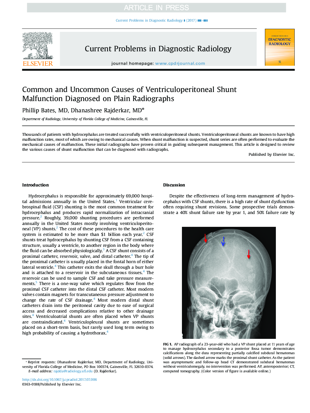 Common and Uncommon Causes of Ventriculoperitoneal Shunt Malfunction Diagnosed on Plain Radiographs