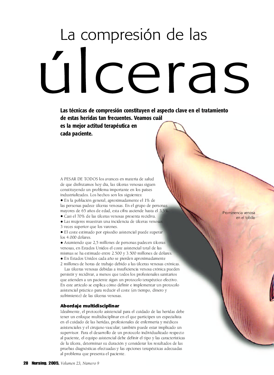 La compresión de las úlceras venosas