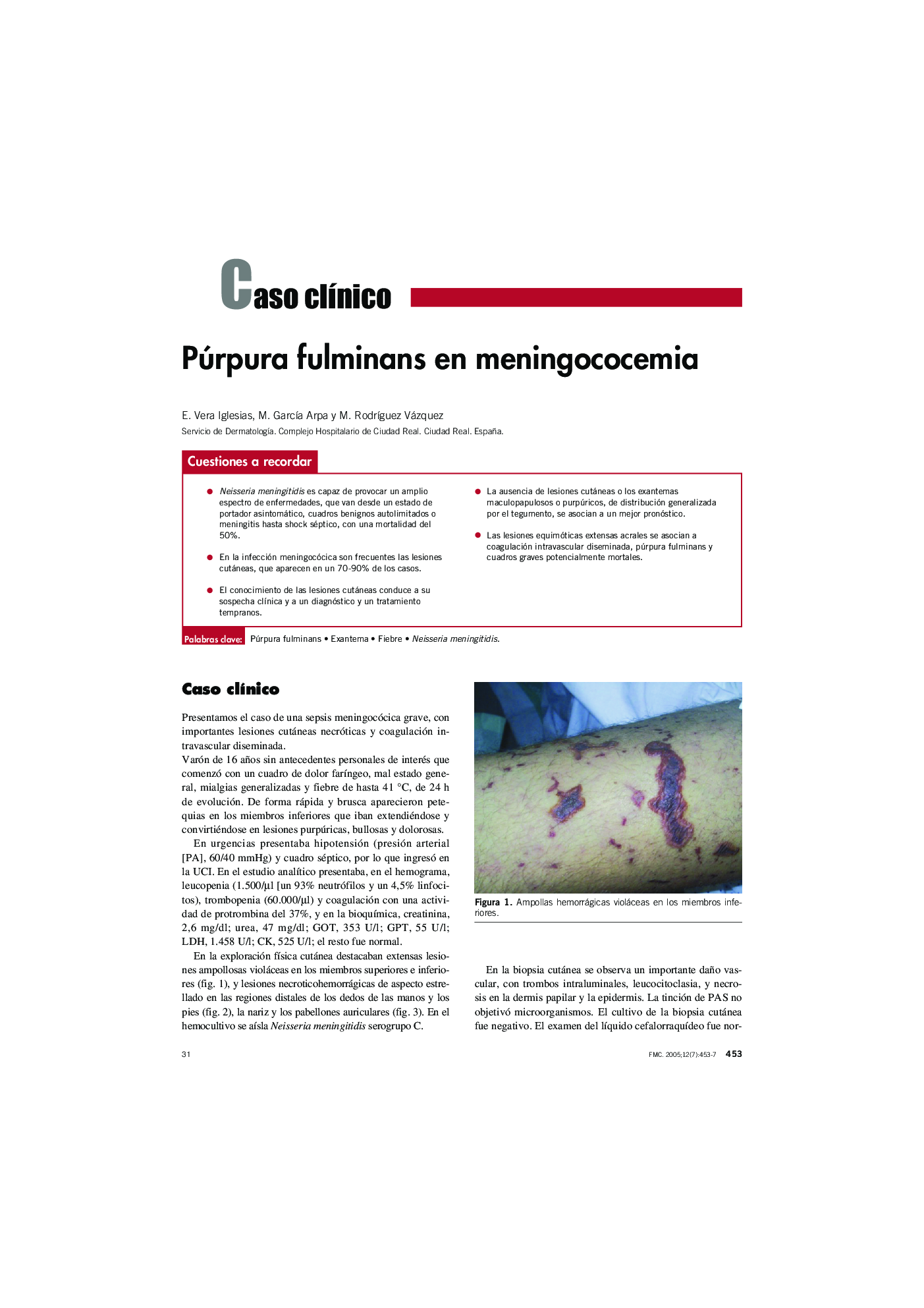 Púrpura fulminans en meningococemia