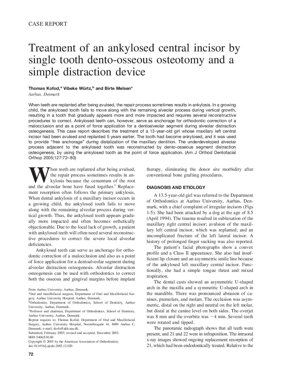 Treatment of an ankylosed central incisor by single tooth dento-osseous osteotomy and a simple distraction device