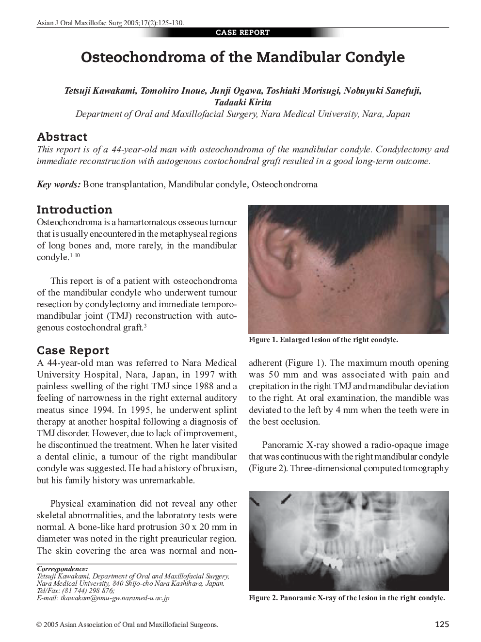 Osteochondroma of the Mandibular Condyle